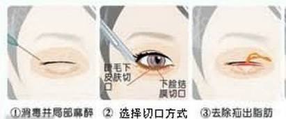 什么是自体肋骨隆鼻,效果怎么样?