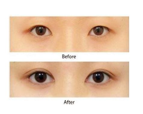 自体脂肪丰胸需要多久可以恢复