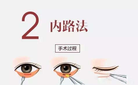 上海矫正牙齿,隐形矫正牙齿适合人群有哪些