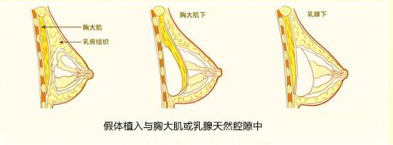 假体隆鼻与膨体隆鼻有什么区别