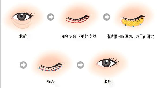 做了假体隆胸多久能变软