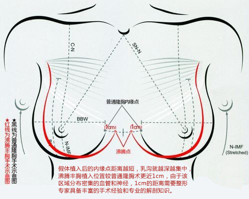 上海做乳房下垂矫正需要多少钱