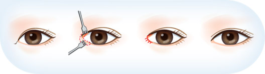 开外眼角的后遗症