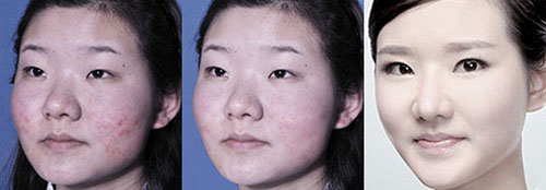 导致一直冒青春痘的诱发因素有哪些