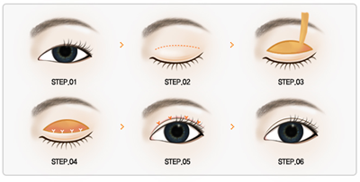 双眼皮失败修复