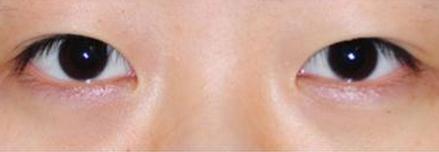 上睑下垂能做双眼皮吗