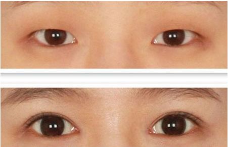 上海上睑下垂如何治疗