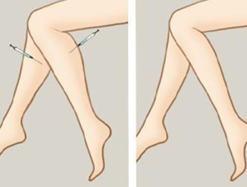 腿部吸脂减肥流程是怎么样的